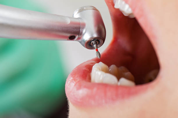 Best Chipped Tooth Repair Near Me  in Garden City, ID